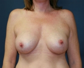 Feel Beautiful - Breast Revision San Diego 11 - After Photo